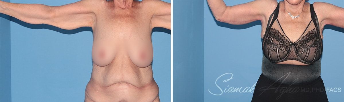 Arm Lift Before & After