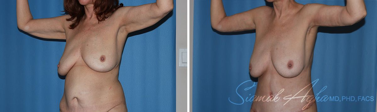 Arm Lift Before & After