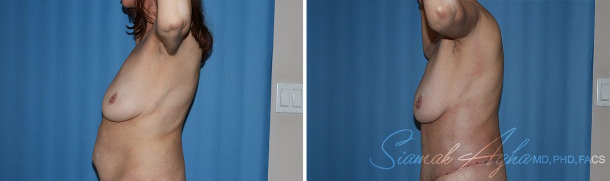 Arm Lift Before & After