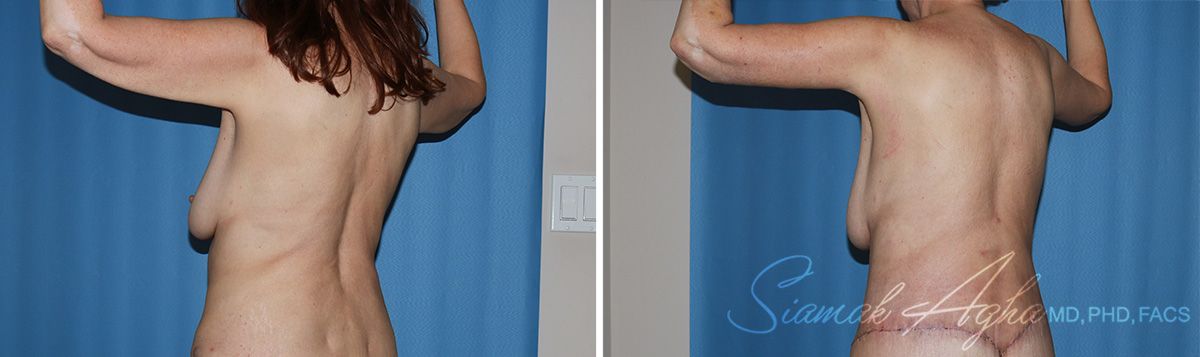 Arm Lift Before & After