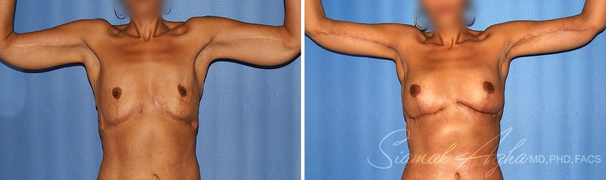 Arm Lift Before & After