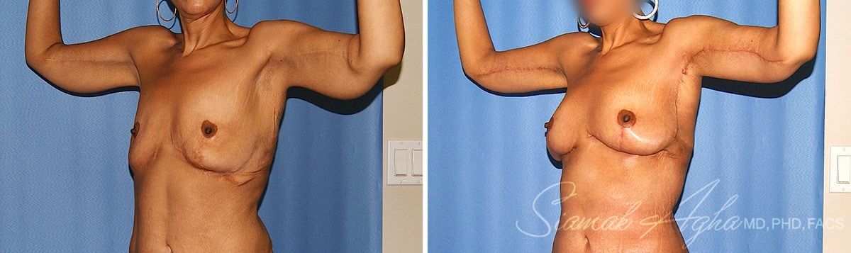 Arm Lift Before & After