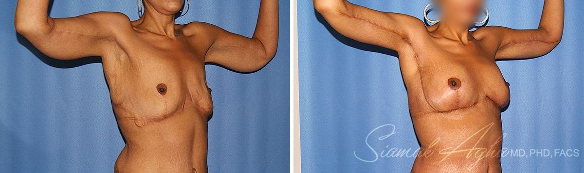 Arm Lift Before & After