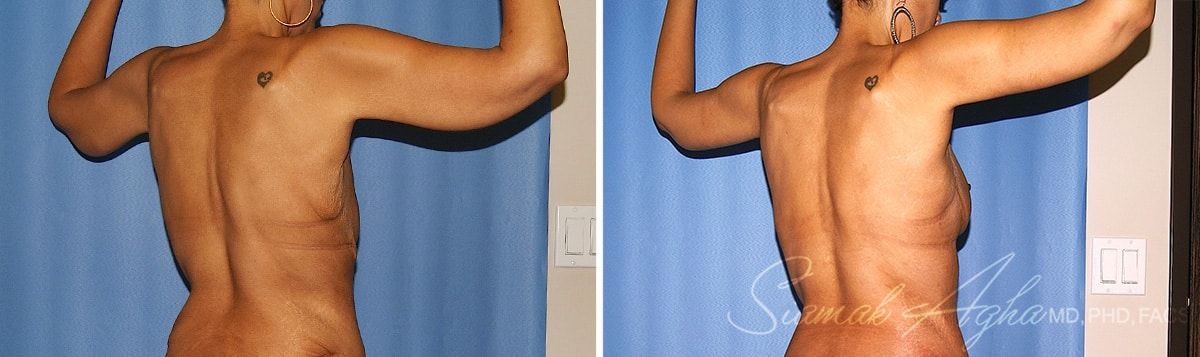 Arm Lift Before & After