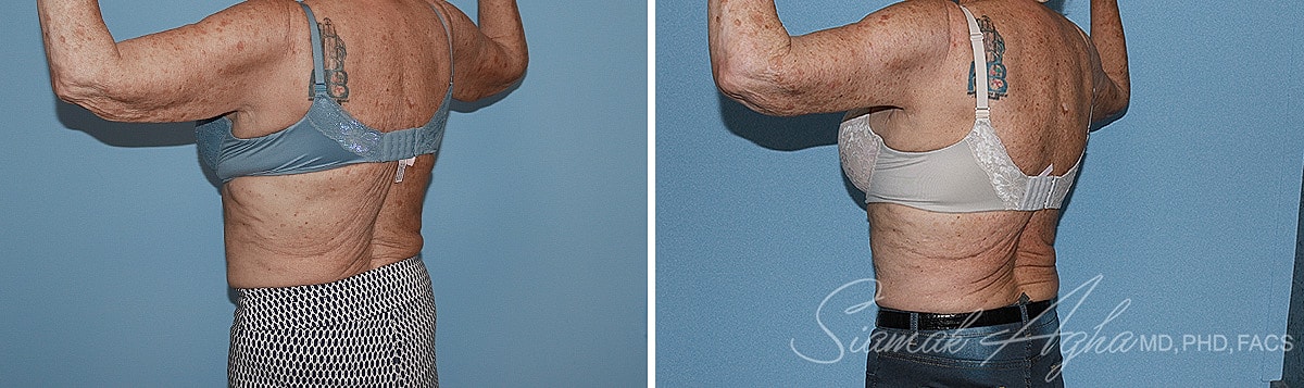 Arm Lift Before & After