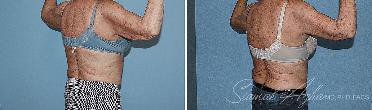 Arm Lift Before & After
