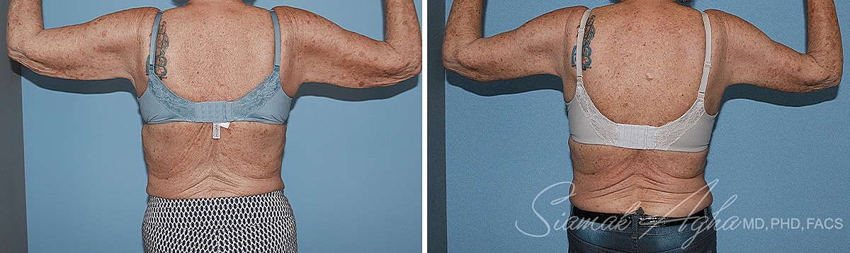 Arm Lift Before & After