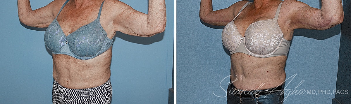 Arm Lift Before & After