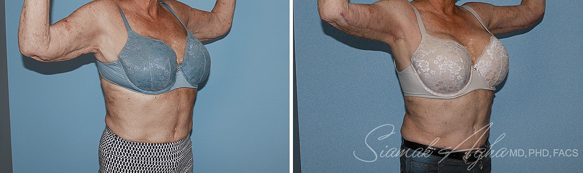 Arm Lift Before & After