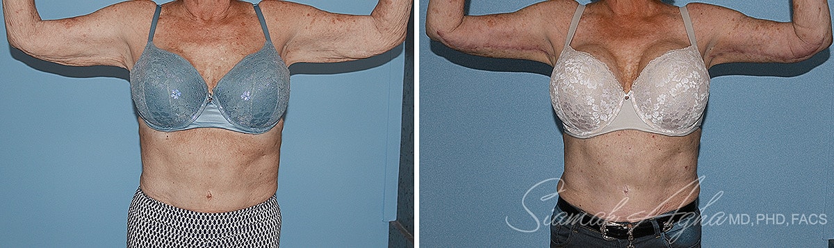 Arm Lift Before & After