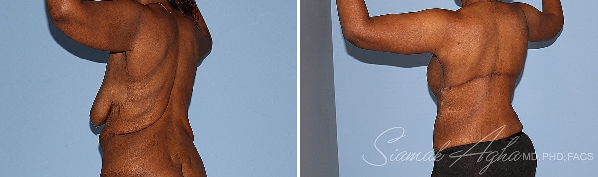 Arm Lift Before & After