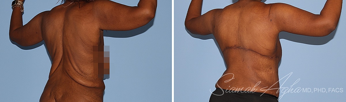 Arm Lift Before & After