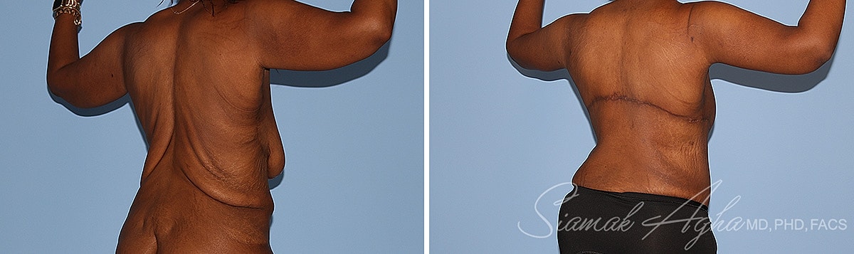 Arm Lift Before & After