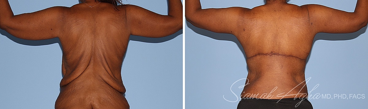 Arm Lift Before & After