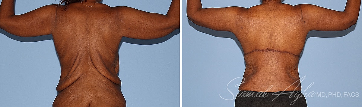 Arm Lift Before & After