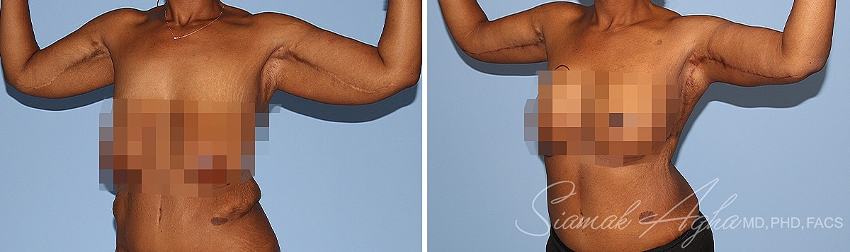 Arm Lift Before & After