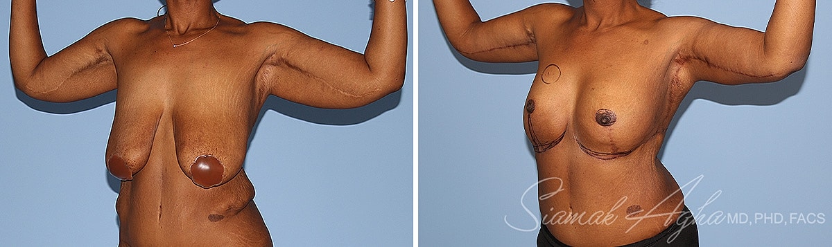 Arm Lift Before & After