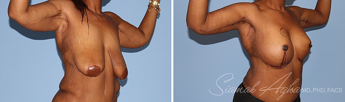 Arm Lift Before & After