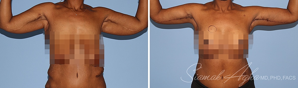 Arm Lift Before & After
