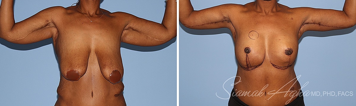 Arm Lift Before & After