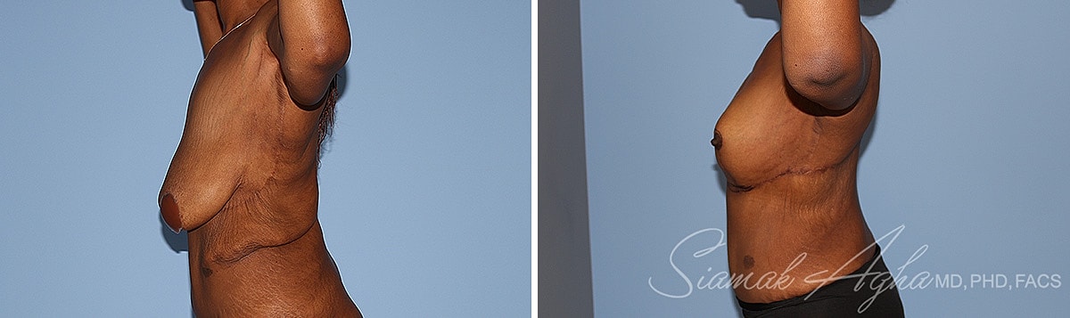 Arm Lift Before & After