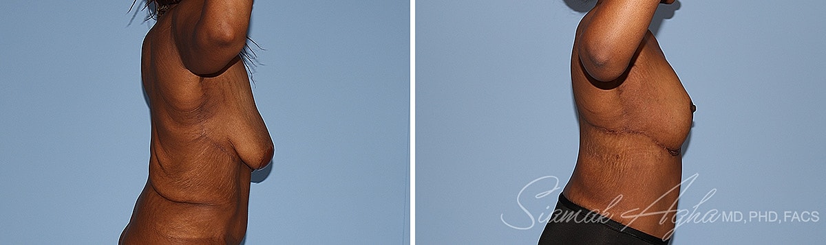 Arm Lift Before & After