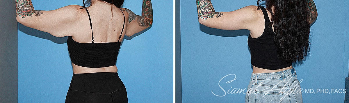 Arm Lift Before & After