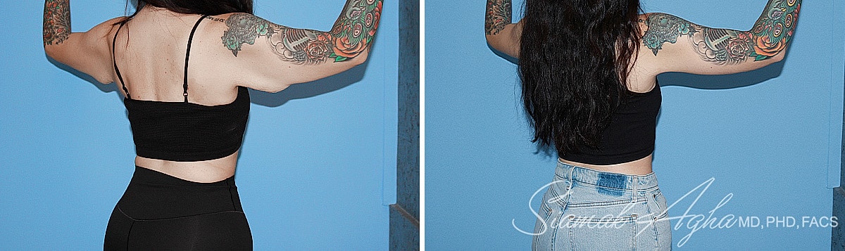 Arm Lift Before & After