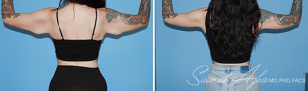 Arm Lift Before & After