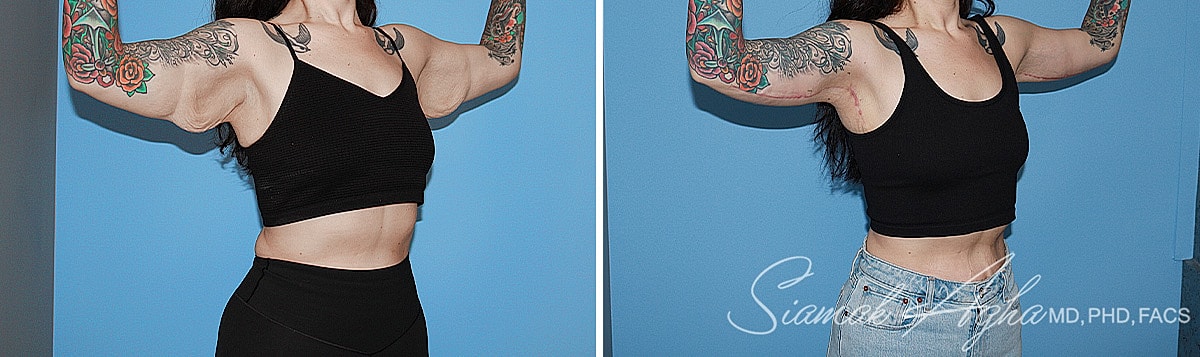 Arm Lift Before & After