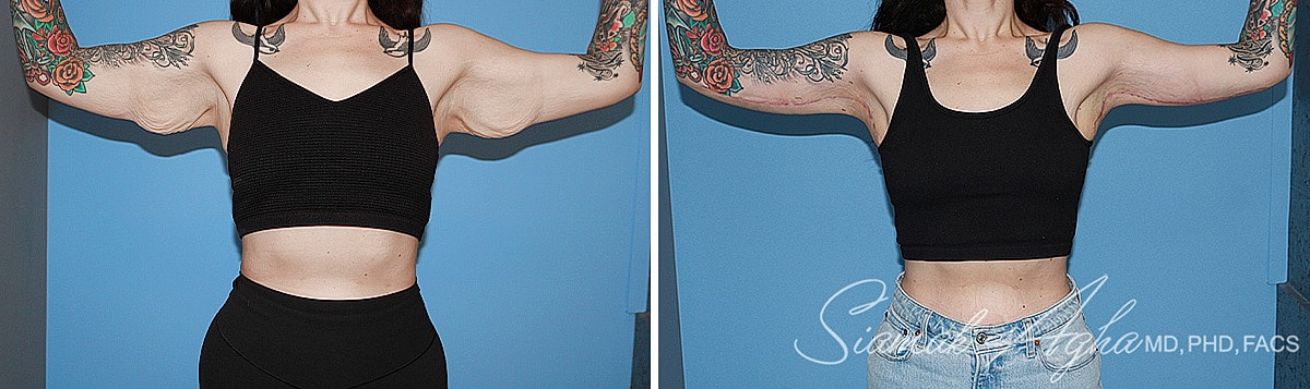 Arm Lift Before & After