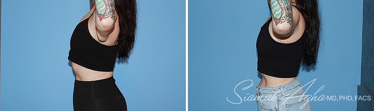 Arm Lift Before & After