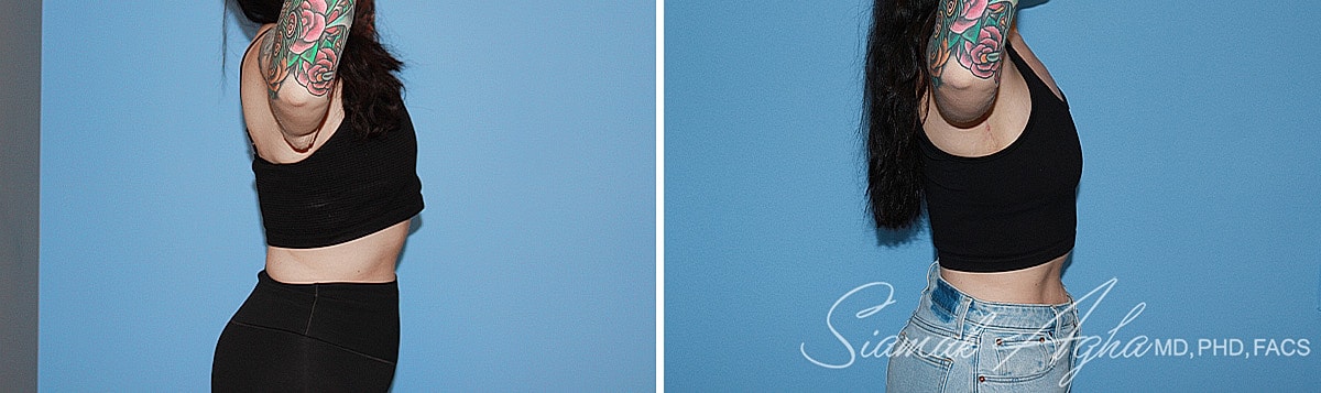 Arm Lift Before & After