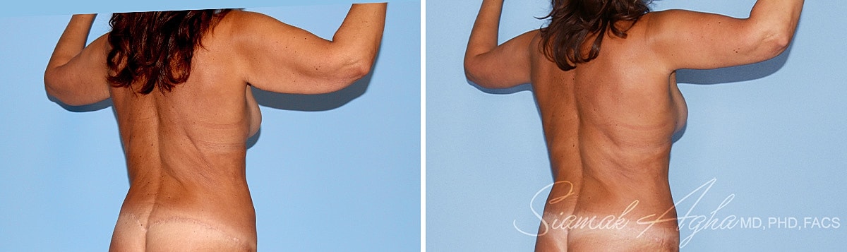 Arm Lift Before & After