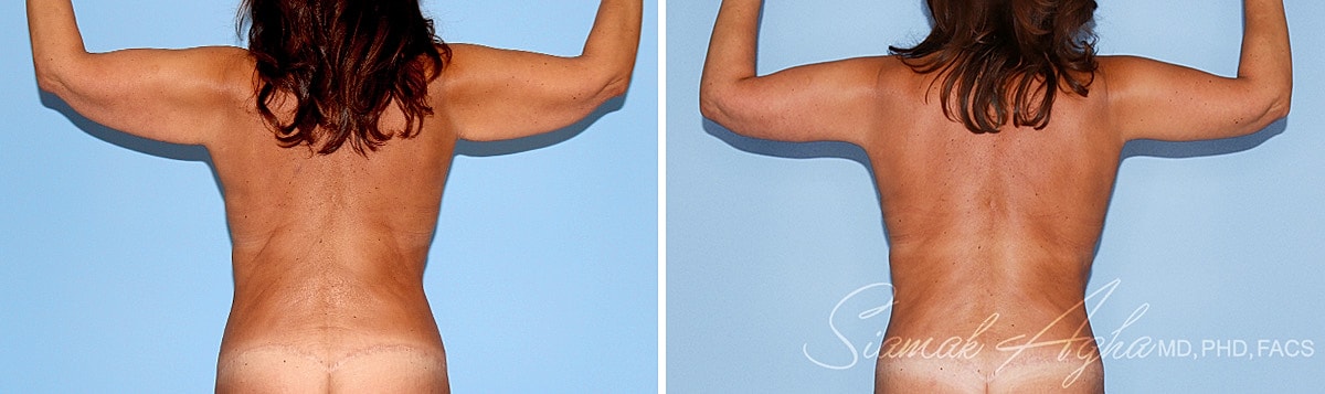 Arm Lift Before & After