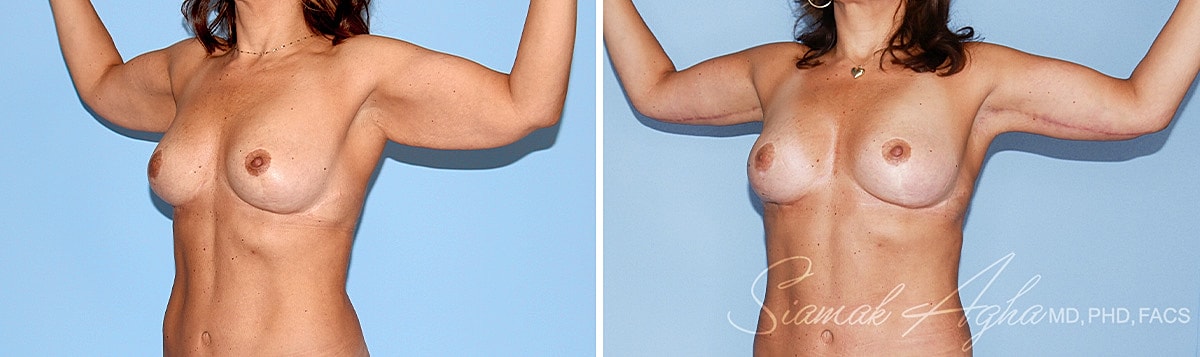 Arm Lift Before & After