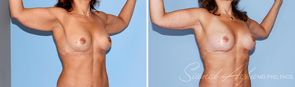 Arm Lift Before & After