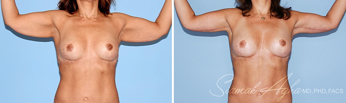 Arm Lift Before & After