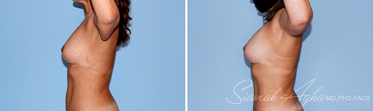 Arm Lift Before & After