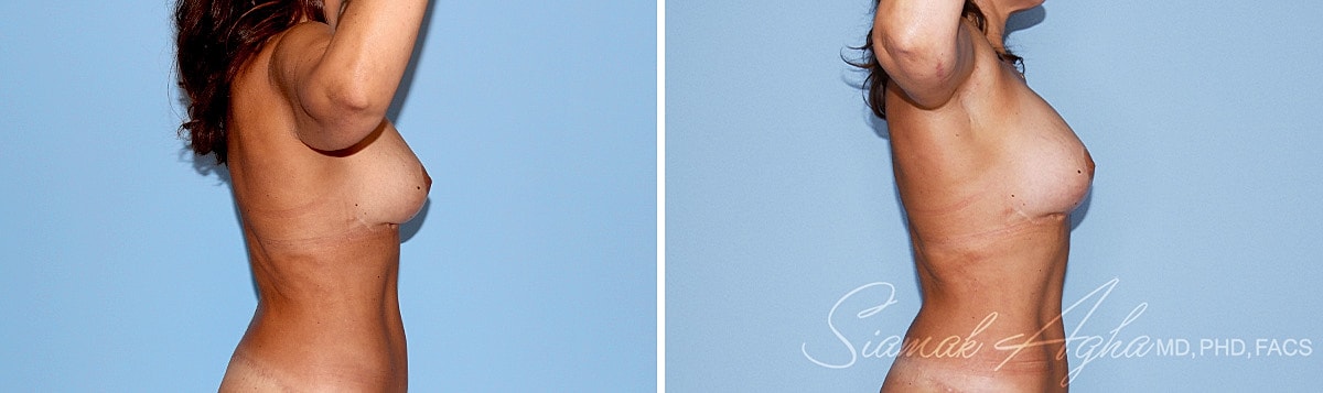 Arm Lift Before & After