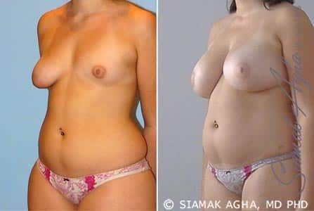 Breast Fat Transfer Before & After