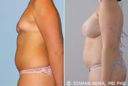 Breast Fat Transfer Before & After