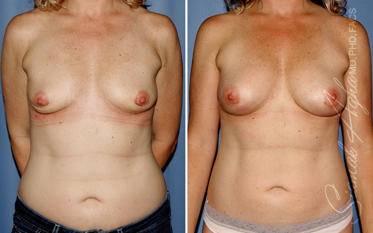 Breast Fat Transfer Before & After