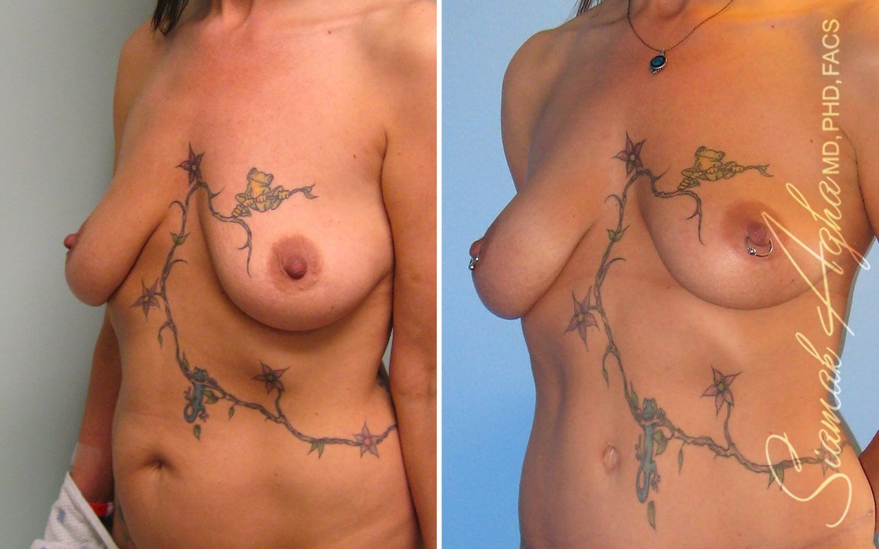 Breast Fat Transfer Before & After