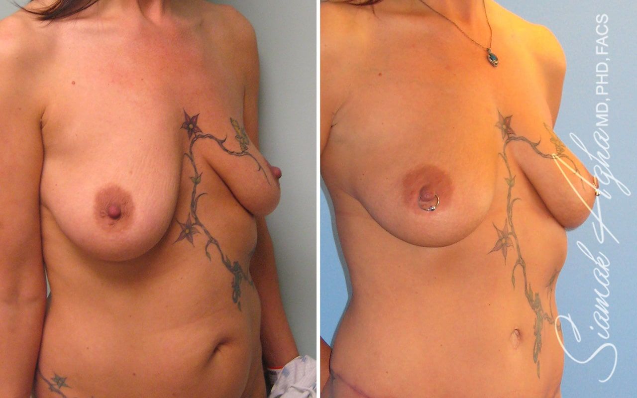 Breast Fat Transfer Before & After