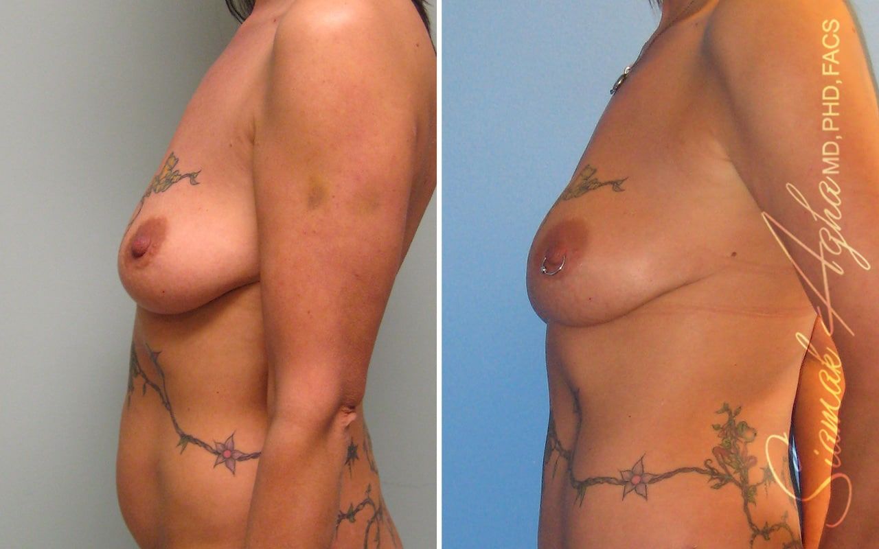 Breast Fat Transfer Before & After