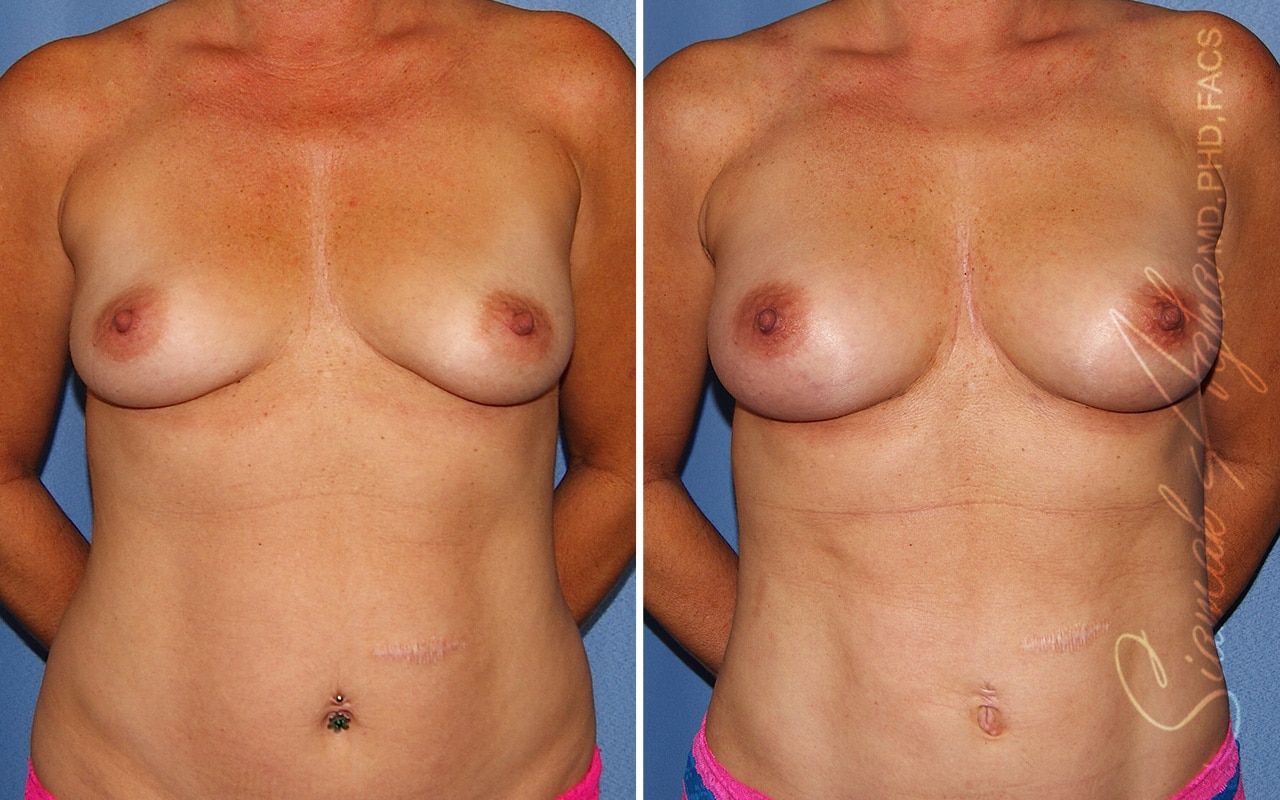 Breast Fat Transfer Before & After