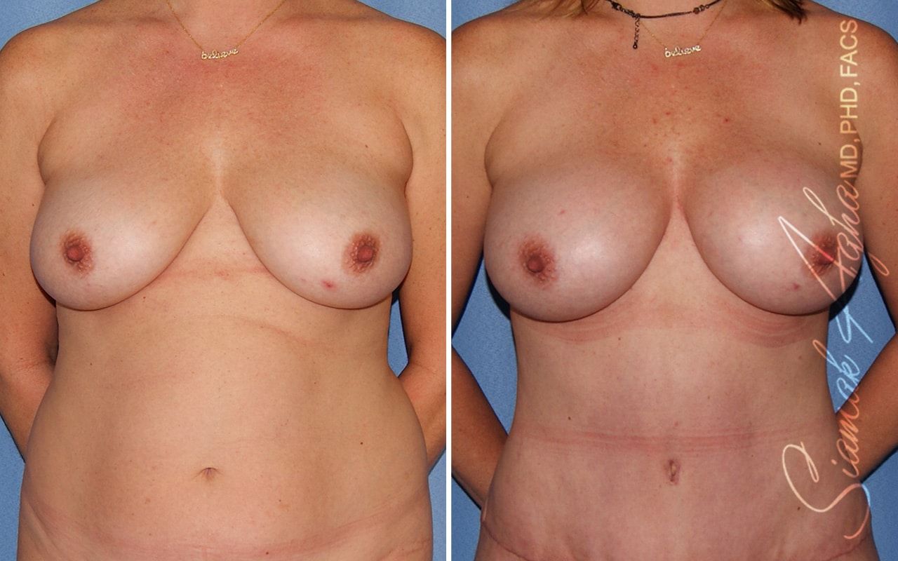 Breast Fat Transfer Before & After