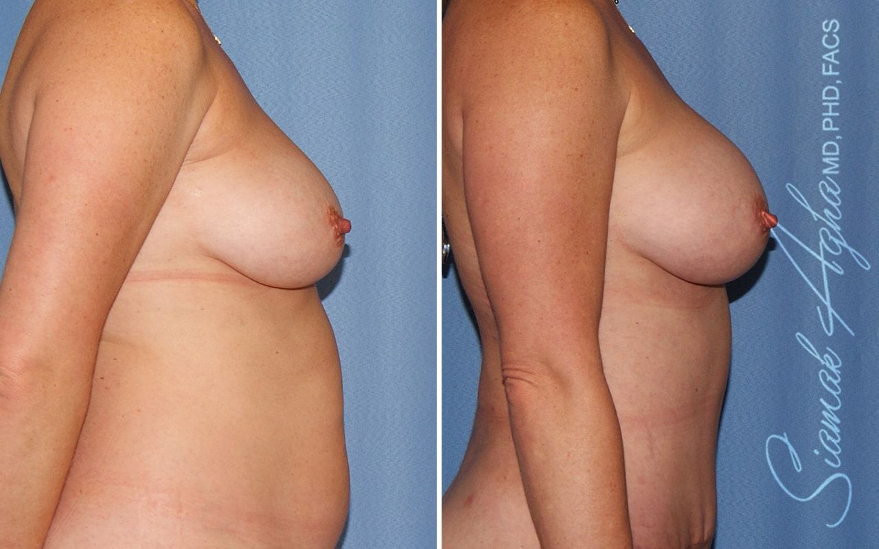 Breast Fat Transfer Before & After