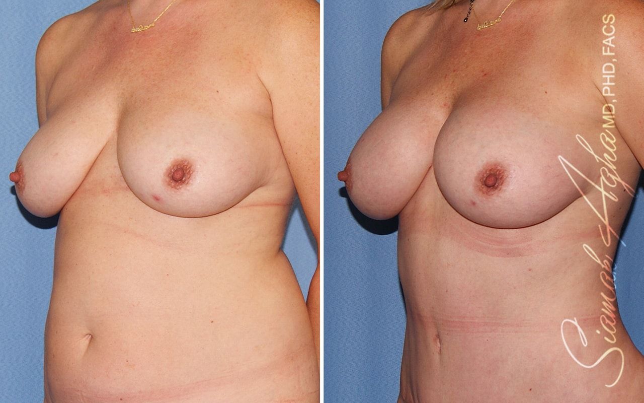 Breast Fat Transfer Before & After